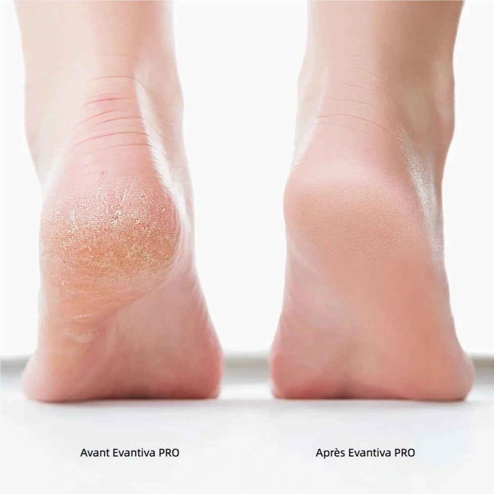 Evantiva Pro 2 – Des pieds doux sans visites coûteuses en salon